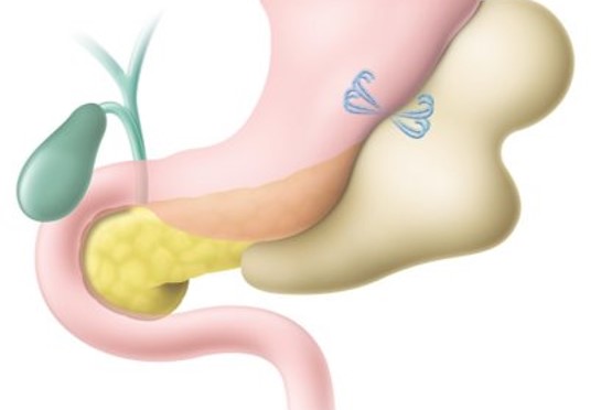 EUS-経胃ドレナージ