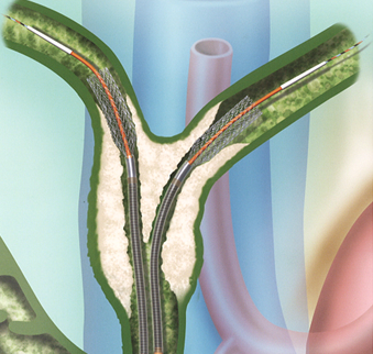 メタリックステント留置術