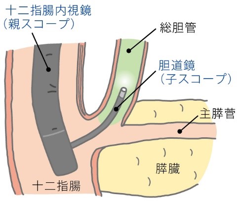 親子方式経口胆道鏡