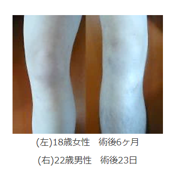 膝前十字靱帯再建術後の傷跡1